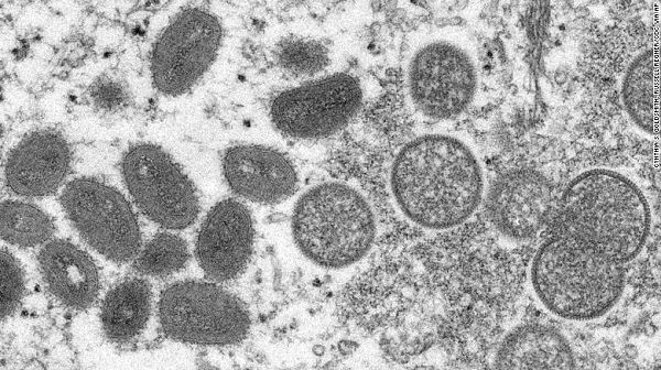 天花表亲猴痘开始在欧美传播，猴痘有什么症状？为啥不必惊慌？
