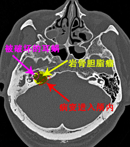 建议患者完善耳部颞骨ct,结果提示居然是颞骨岩部胆脂瘤,这才是导致其